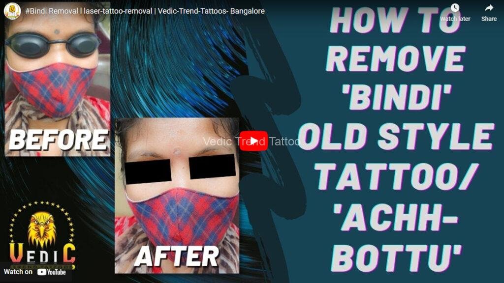 Tattoo removal at vedic trend tattoo youtube thumbnail