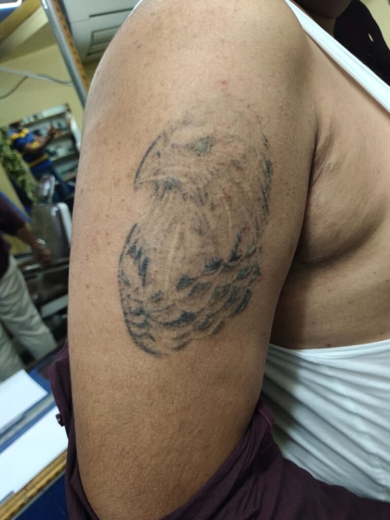 Tattoo removal laser cost analysis for effective eyebrow tattoo removal and other tattoos.